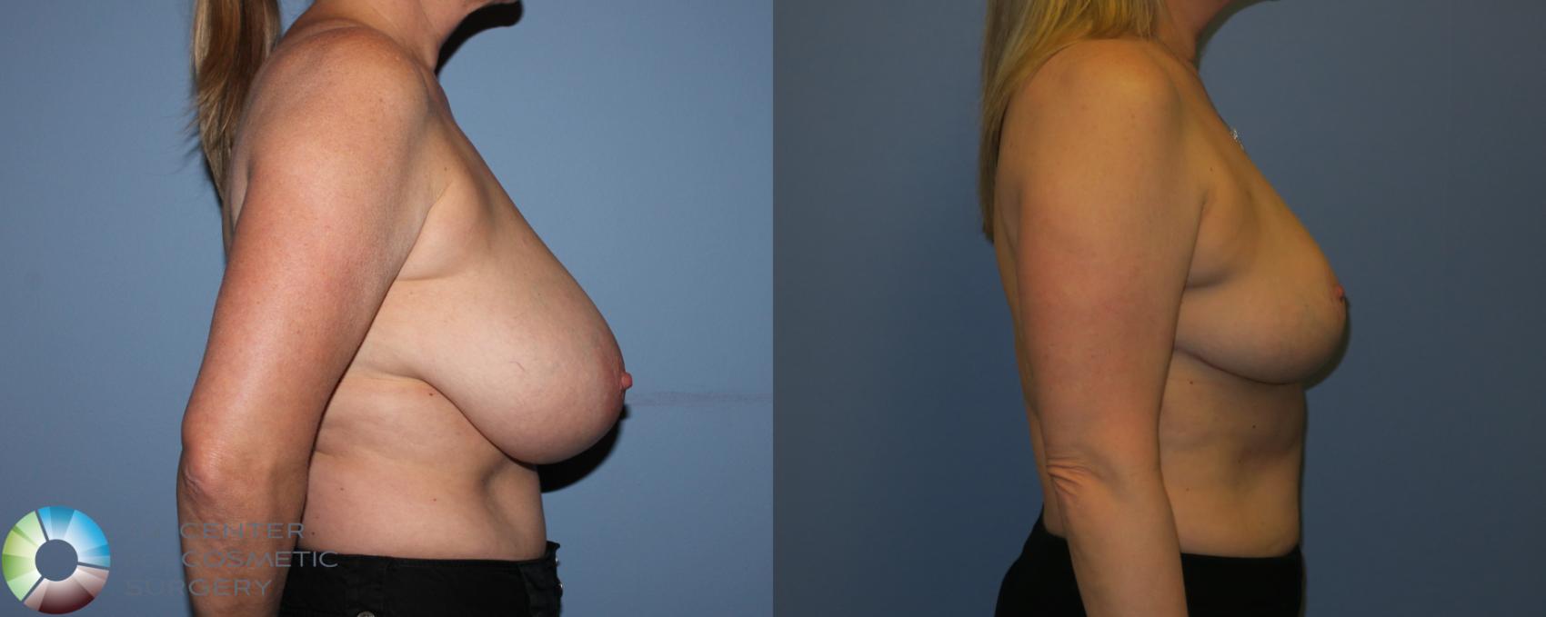 Before & After Breast Reduction Case 11288 Right Side View in Denver & Golden, CO