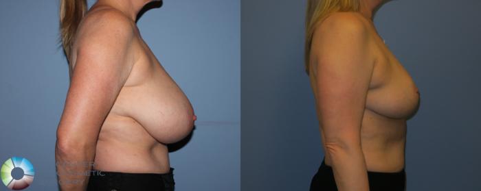 Before & After Breast Reduction Case 11288 Right Side View in Golden, CO