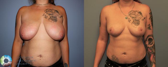 Before & After Breast Reduction Case 11289 Front in Denver and Colorado Springs, CO