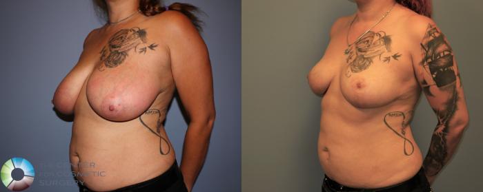 Before & After Breast Reduction Case 11289 Left Oblique in Denver and Colorado Springs, CO