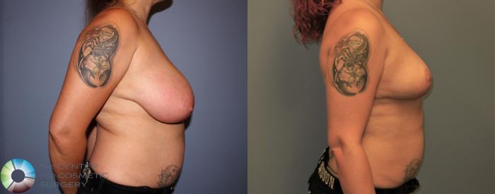 Before & After Breast Reduction Case 11289 Right Side in Denver and Colorado Springs, CO