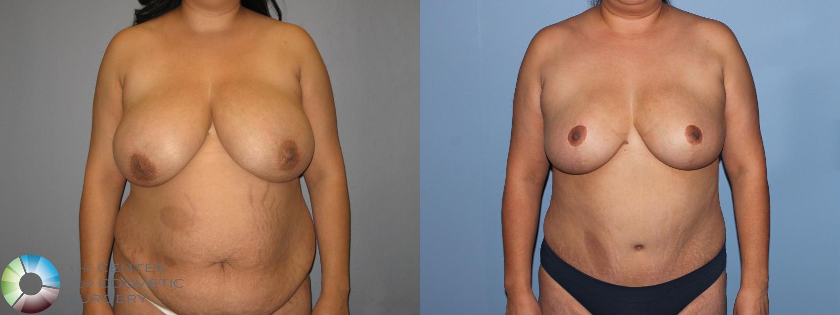 Before & After Breast Reduction Case 11290 Front in Denver and Colorado Springs, CO