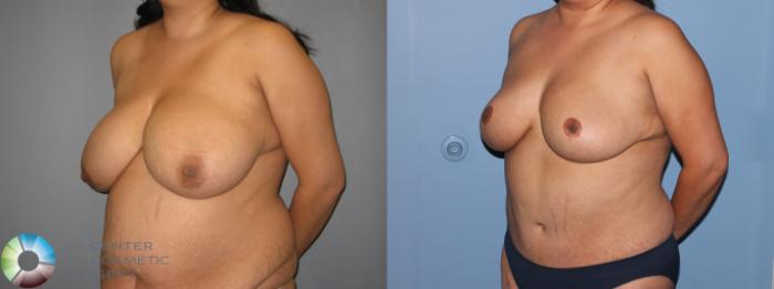 Before & After Breast Reduction Case 11290 Left Oblique View in Golden, CO