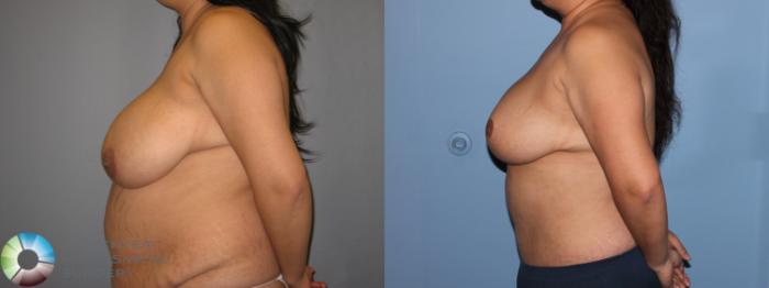 Before & After Breast Reduction Case 11290 Left Side View in Golden, CO