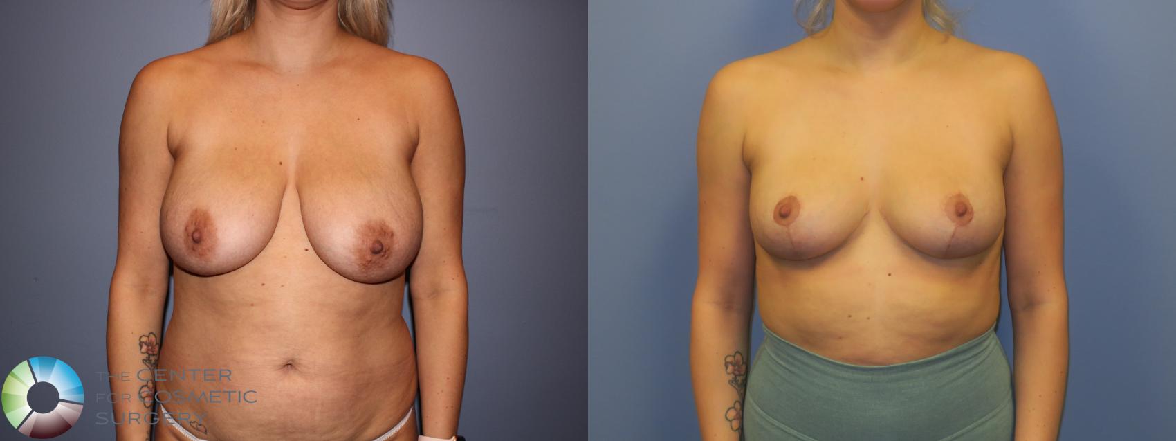 Before & After Breast Reduction Case 11291 Front View in Golden, CO