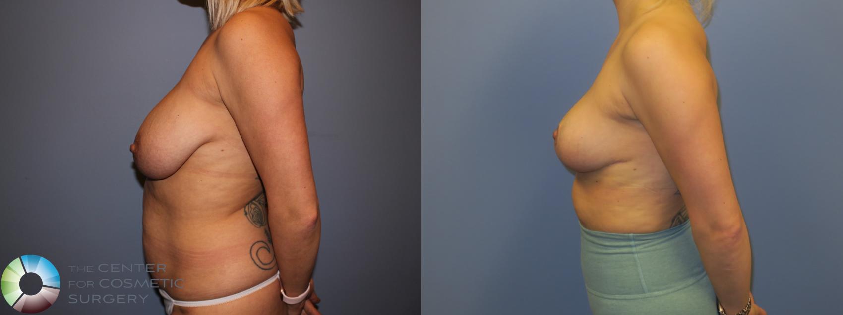 Before & After Breast Reduction Case 11291 Left Side View in Denver & Golden, CO