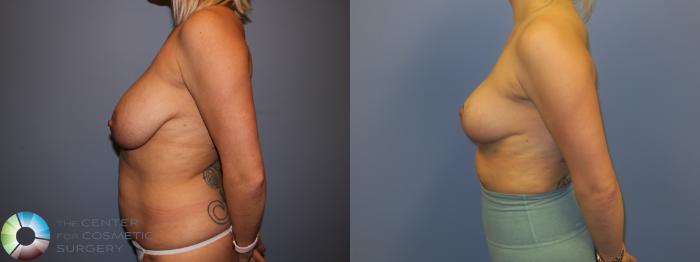 Before & After Breast Reduction Case 11291 Left Side in Denver and Colorado Springs, CO