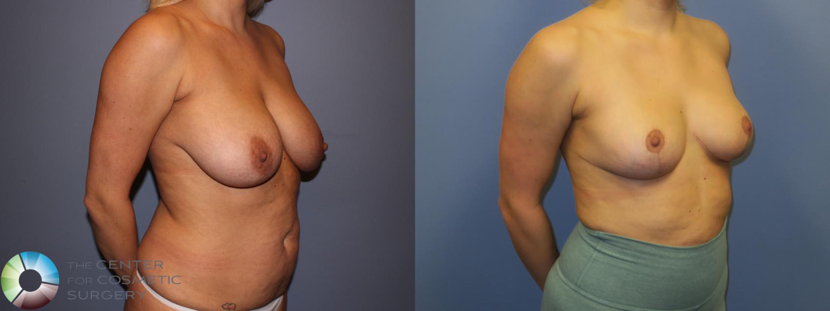 Before & After Breast Reduction Case 11291 Right Oblique View in Denver & Golden, CO