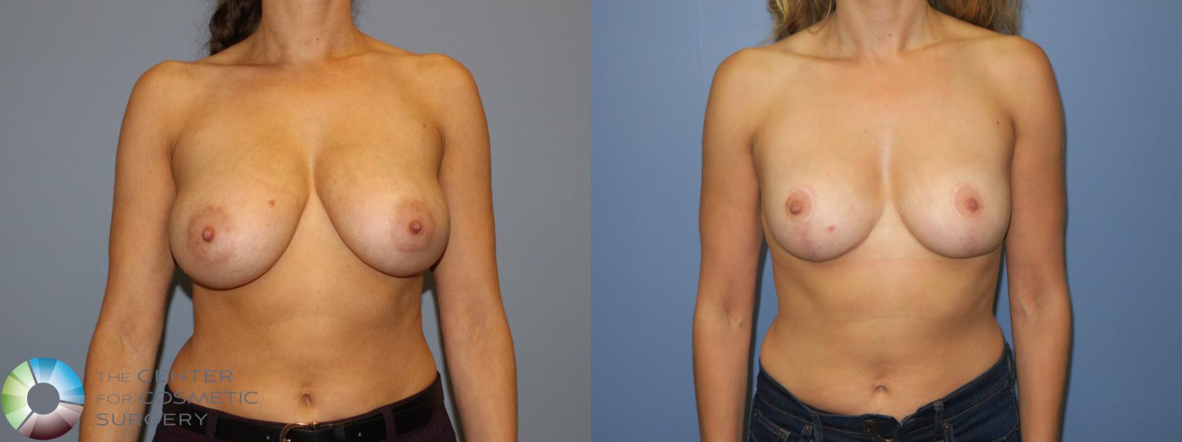 Before & After Breast Reduction Case 11294 Front in Denver and Colorado Springs, CO