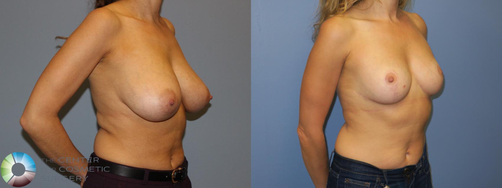 Before & After Breast Reduction Case 11294 Right Oblique in Denver and Colorado Springs, CO