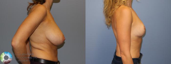 Before & After Breast Reduction Case 11294 Right Side View in Golden, CO