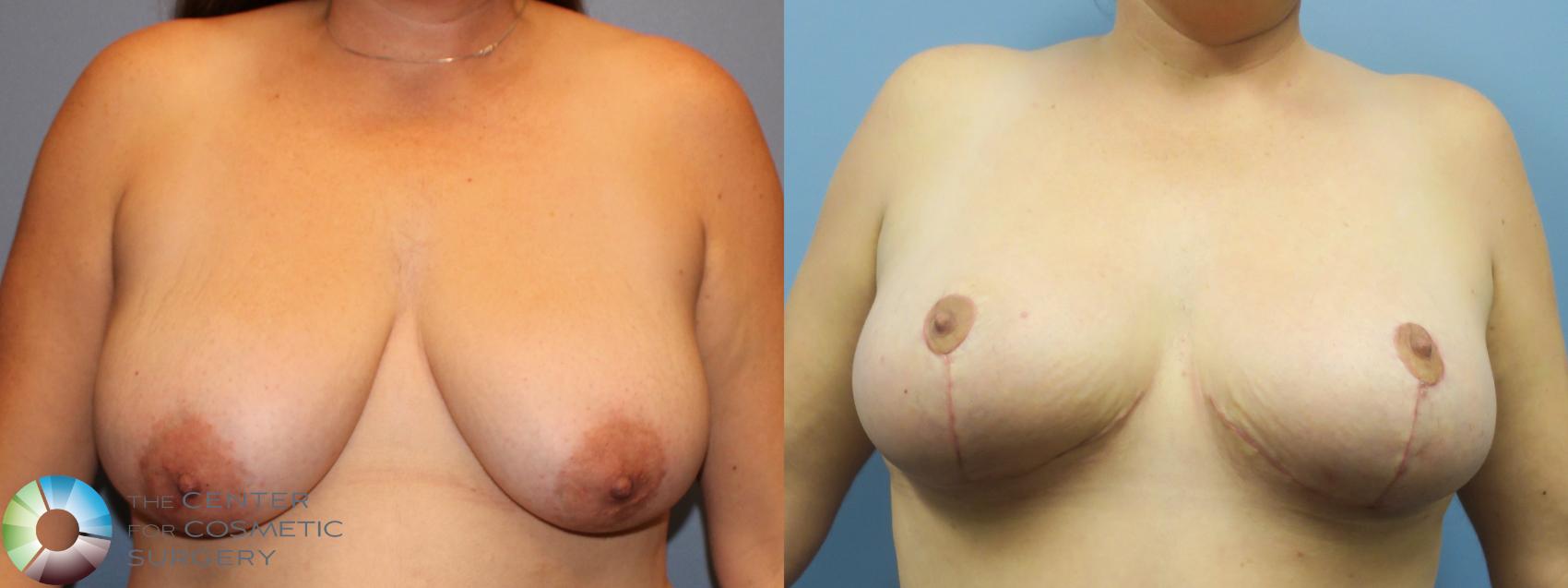 Best Denver Breast Reduction/Lift