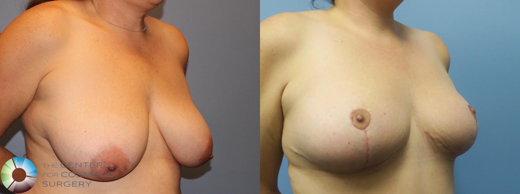 Before & After Breast Reduction Case 11466 Right Oblique in Denver and Colorado Springs, CO