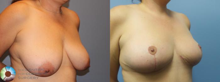 Best Denver Breast Reduction/Lift