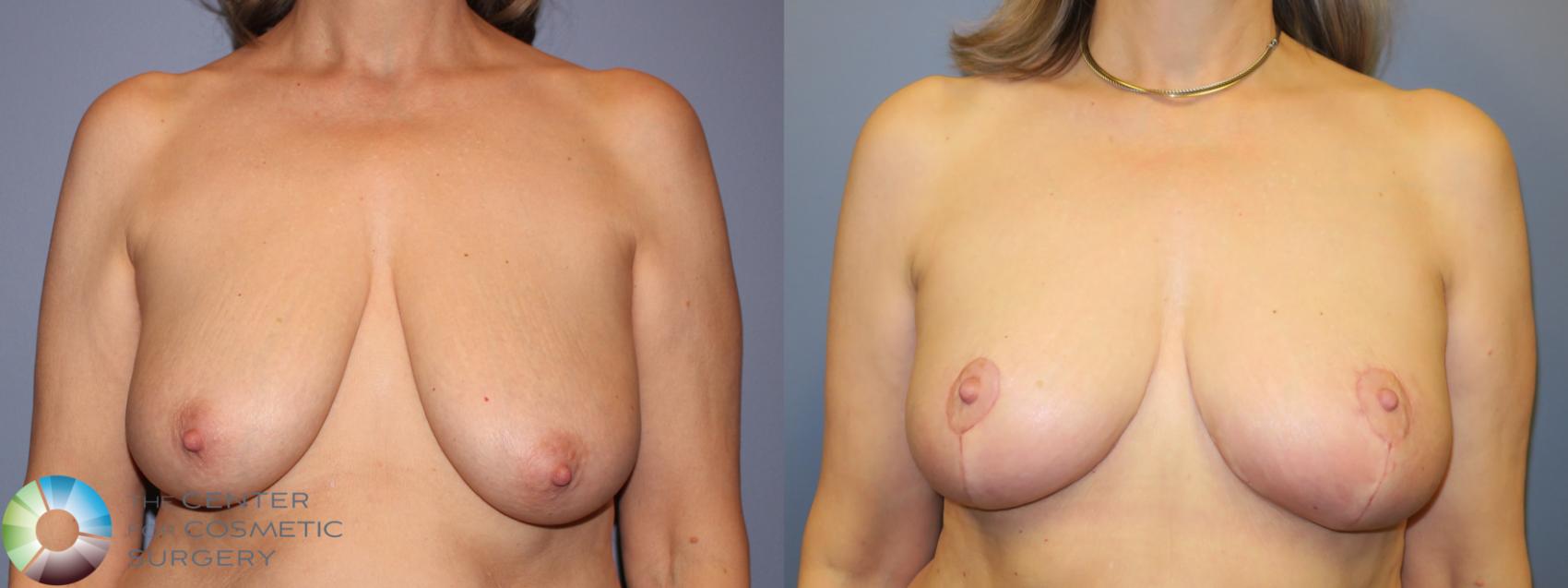 Best Denver Breast Reduction Lift