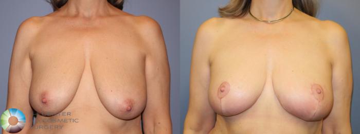 Before & After Breast Reduction Case 11509 Front View in Golden, CO