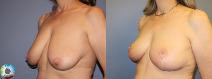 Before & After Breast Reduction Case 11509 Left Oblique View in Golden, CO
