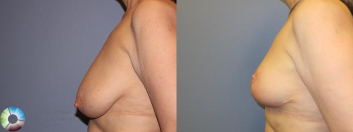 Before & After Breast Reduction Case 11509 Left Side View in Golden, CO