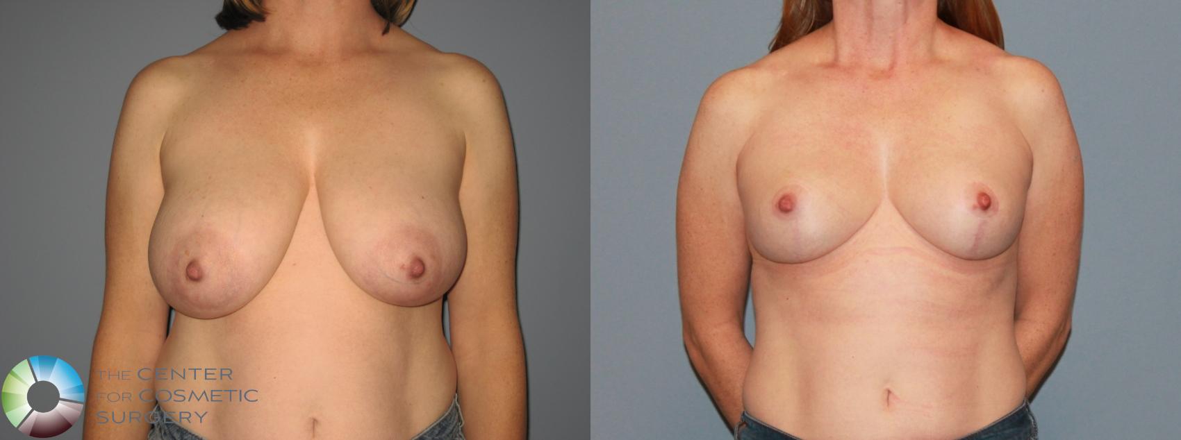 Before & After Breast Reduction Case 11536 Front in Denver and Colorado Springs, CO