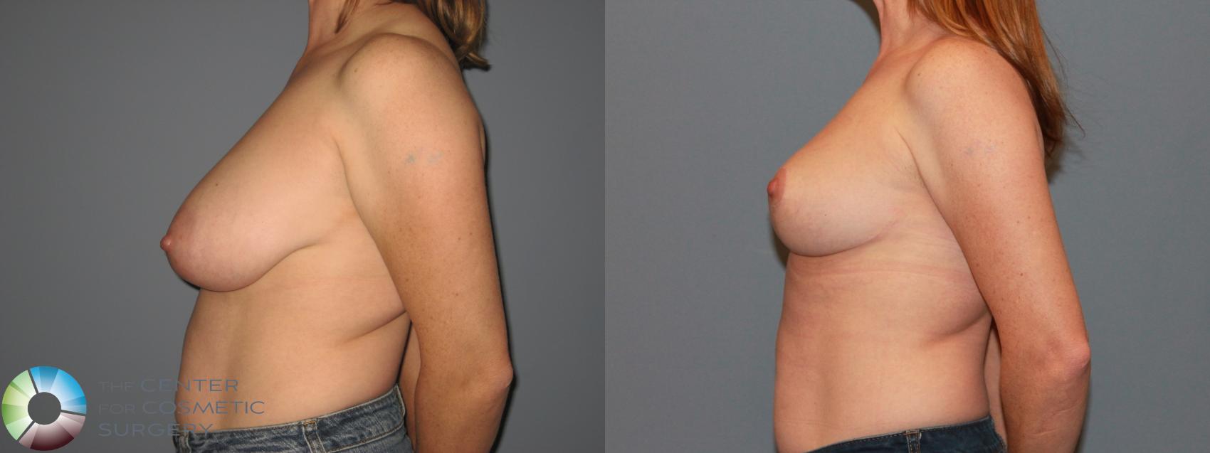 Before & After Breast Reduction Case 11536 Left Side in Denver and Colorado Springs, CO