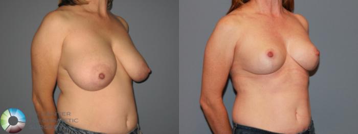 Before & After Breast Reduction Case 11536 Right Oblique View in Golden, CO