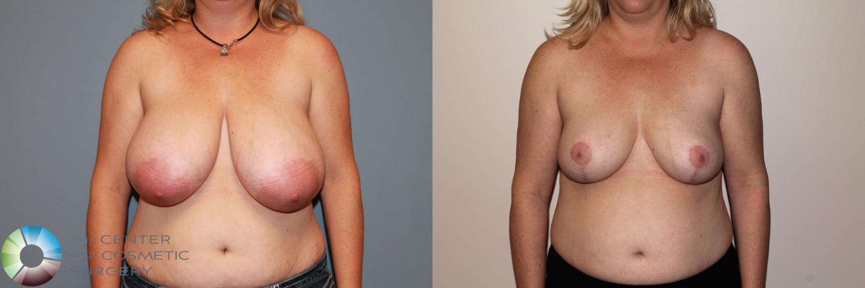Before & After Breast Reduction Case 11540 Front View in Golden, CO