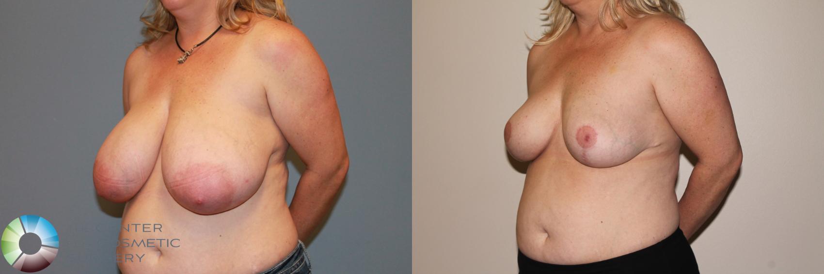 Before & After Breast Reduction Case 11540 Left Oblique in Denver and Colorado Springs, CO