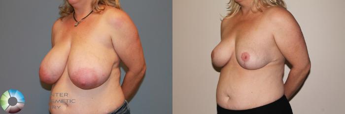 Before & After Breast Reduction Case 11540 Left Oblique View in Golden, CO