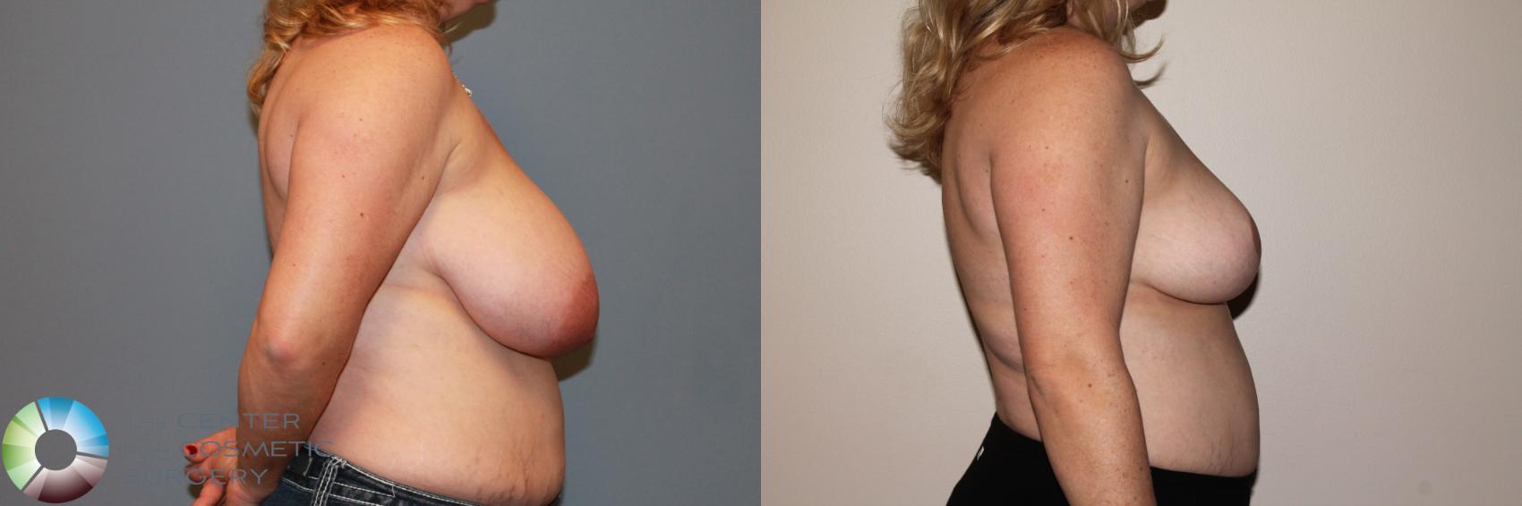 Before & After Breast Reduction Case 11540 Right Side in Denver and Colorado Springs, CO
