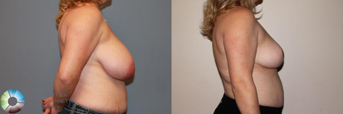 Before & After Breast Reduction Case 11540 Right Side View in Golden, CO