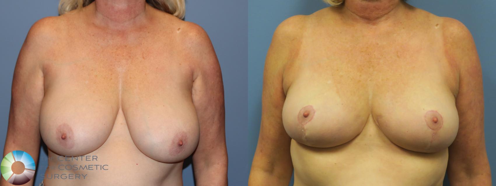 Before & After Breast Reduction Case 11697 Front View in Golden, CO