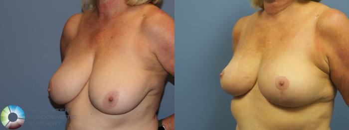 Before & After Breast Reduction Case 11697 Left Oblique View in Golden, CO