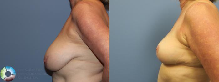 Before & After Breast Reduction Case 11697 Left Side View in Golden, CO