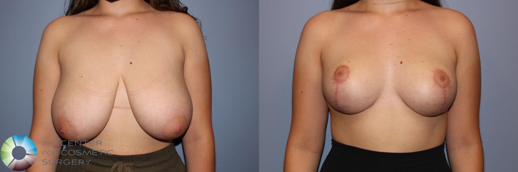 Before & After Breast Reduction Case 11714 Front View in Golden, CO