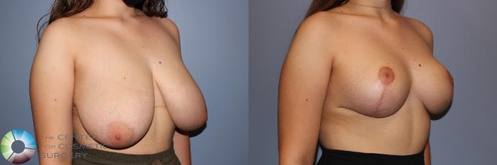 Before & After Breast Reduction Case 11714 Right Oblique View in Golden, CO