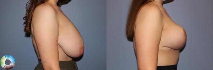 Before & After Breast Reduction Case 11714 Right Side View in Golden, CO