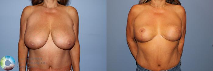 Before & After Breast Reduction Case 11745 Front in Denver and Colorado Springs, CO