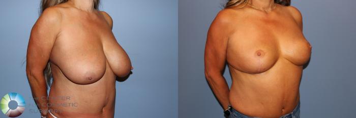 Before & After Breast Reduction Case 11745 Right Oblique in Denver and Colorado Springs, CO