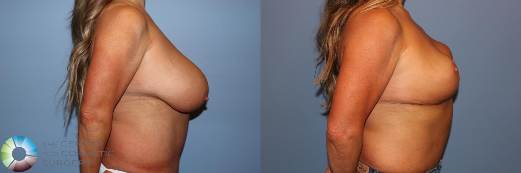 Before & After Breast Reduction Case 11745 Right Side in Denver and Colorado Springs, CO