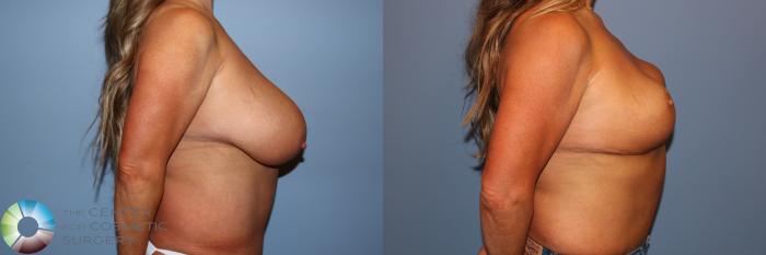 Before & After Breast Reduction Case 11745 Right Side in Denver and Colorado Springs, CO