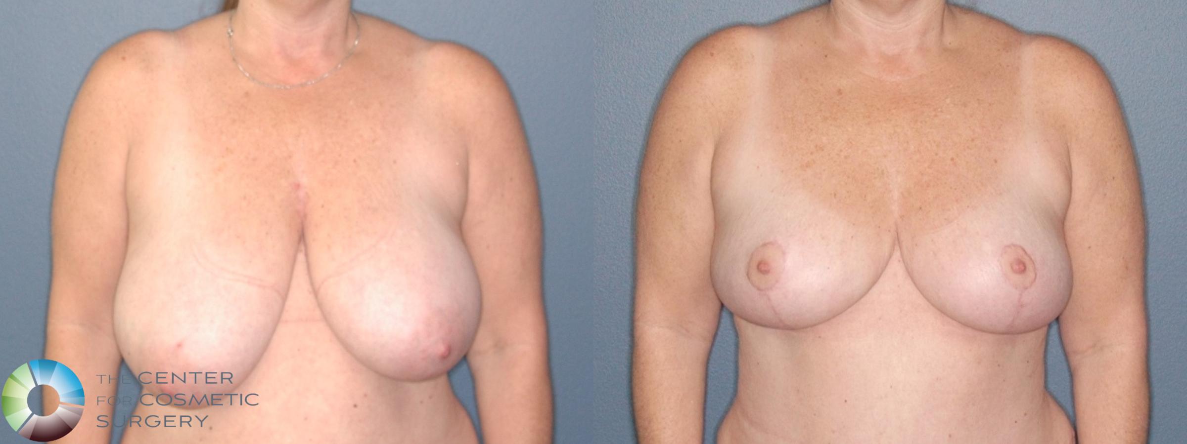 Before & After Breast Reduction Case 11840 Front View in Denver & Golden, CO