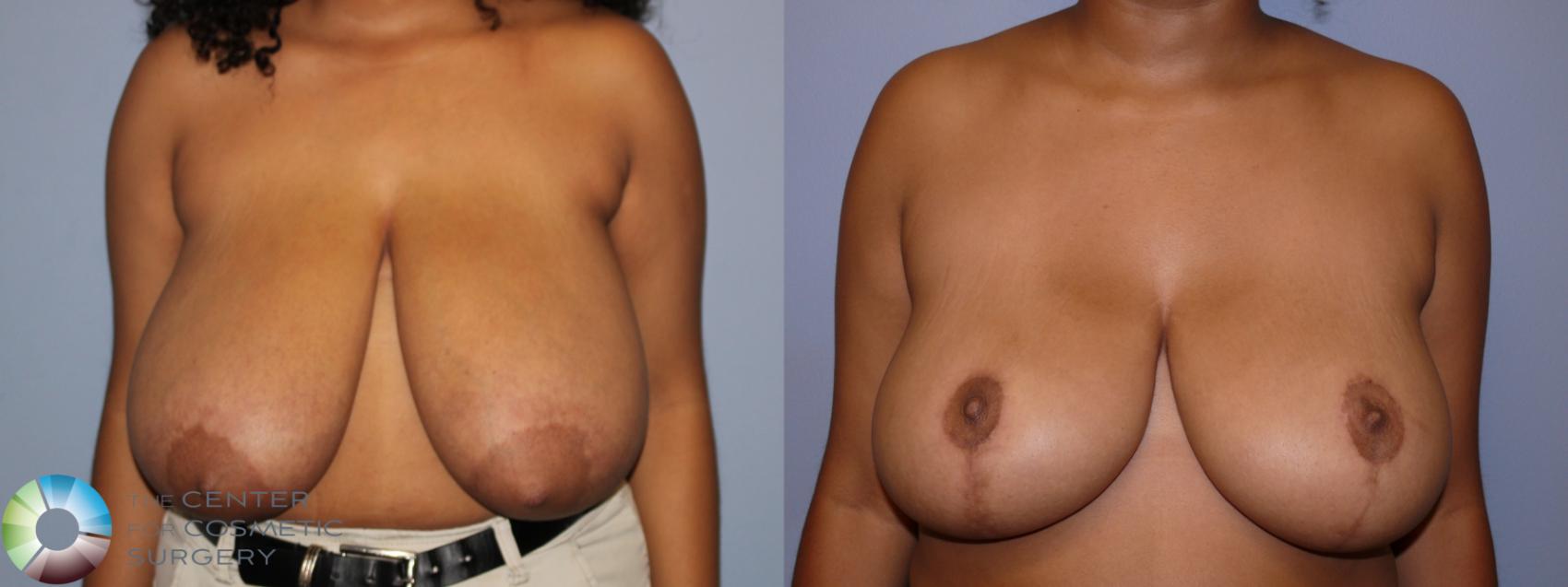 Before & After Breast Reduction Case 11872 Front in Denver and Colorado Springs, CO