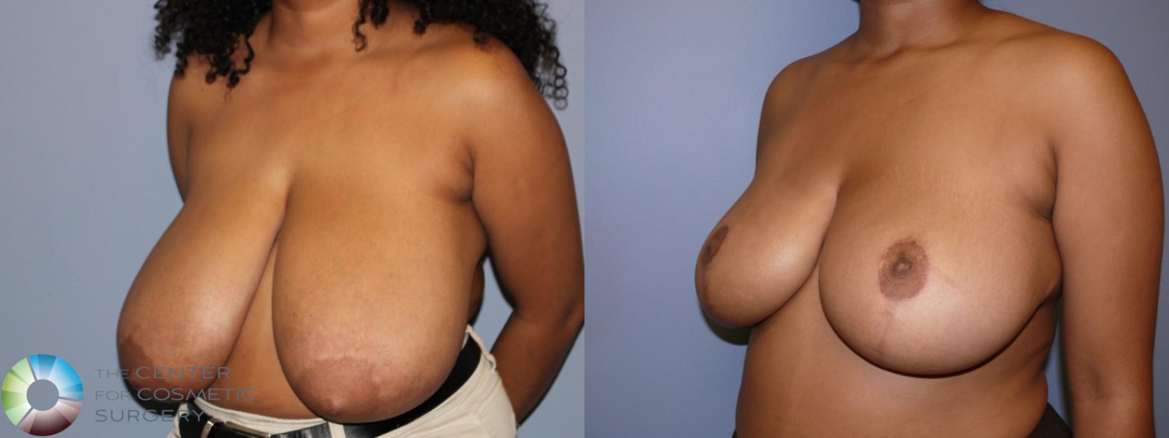 Before & After Breast Reduction Case 11872 Left Oblique in Denver and Colorado Springs, CO