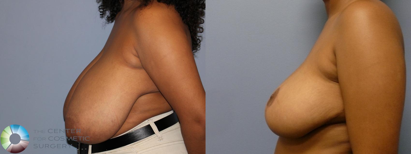 Before & After Breast Reduction Case 11872 Left Side in Denver and Colorado Springs, CO