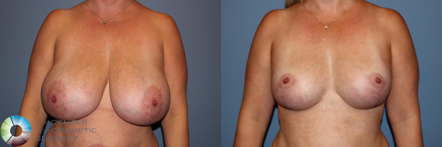 Before & After Breast Reduction Case 11883 Front View in Golden, CO