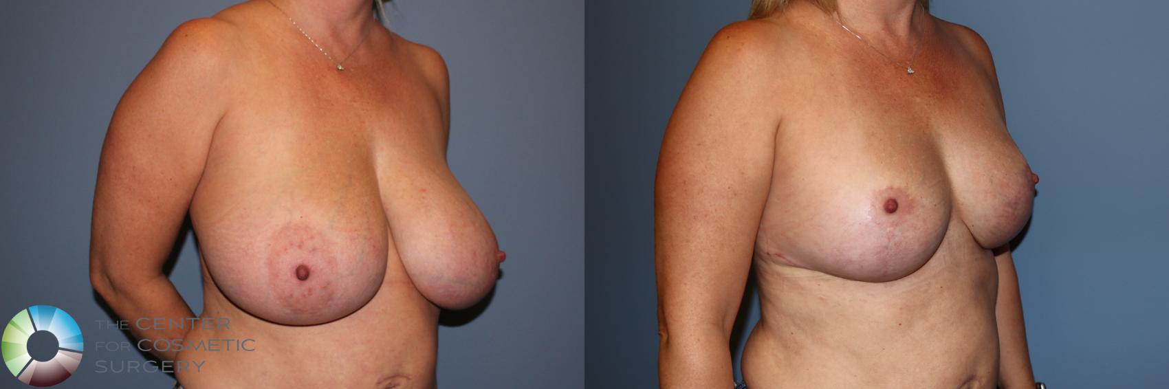 Before & After Breast Reduction Case 11883 Right Oblique in Denver and Colorado Springs, CO