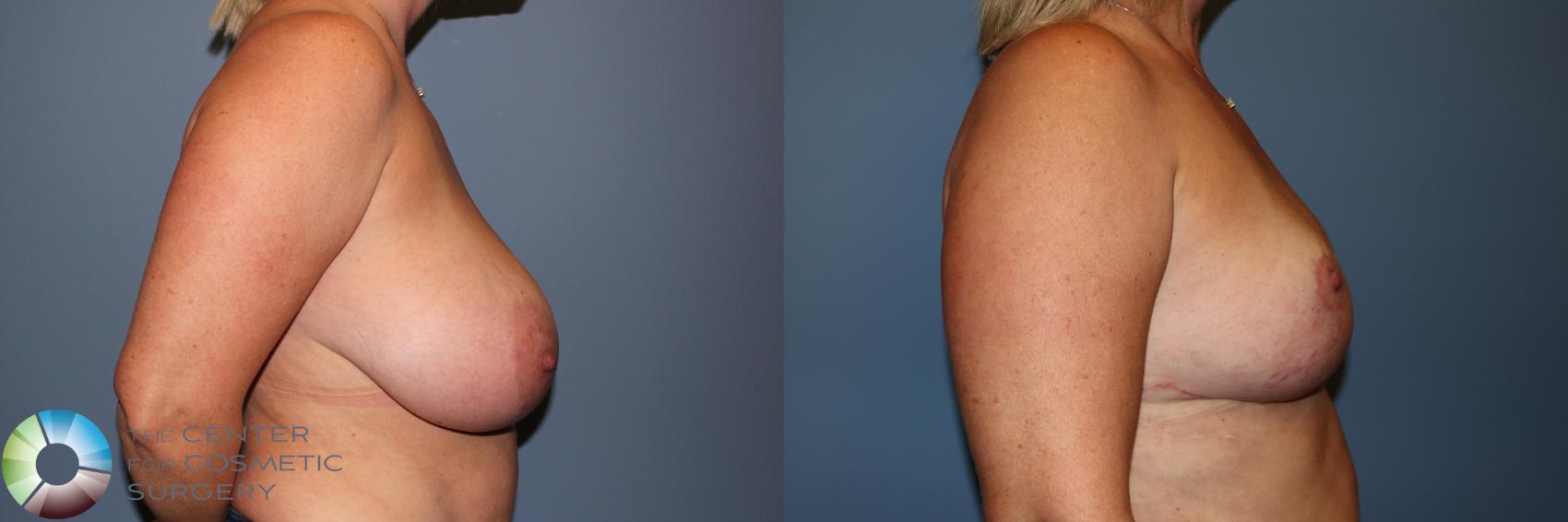 Before & After Breast Reduction Case 11883 Right Side in Denver and Colorado Springs, CO