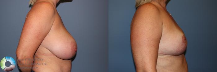 Before & After Breast Reduction Case 11883 Right Side View in Golden, CO