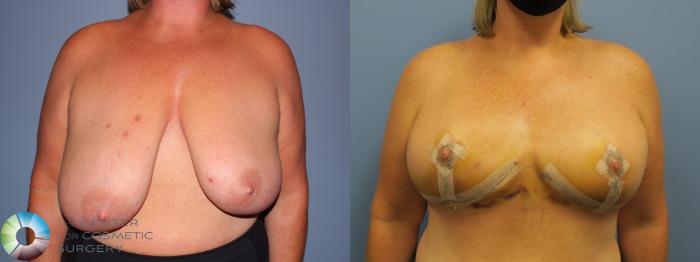 Before & After Breast Reduction Case 11928 Front View in Golden, CO