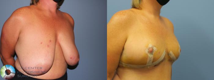 Before & After Breast Reduction Case 11928 Right Oblique View in Golden, CO